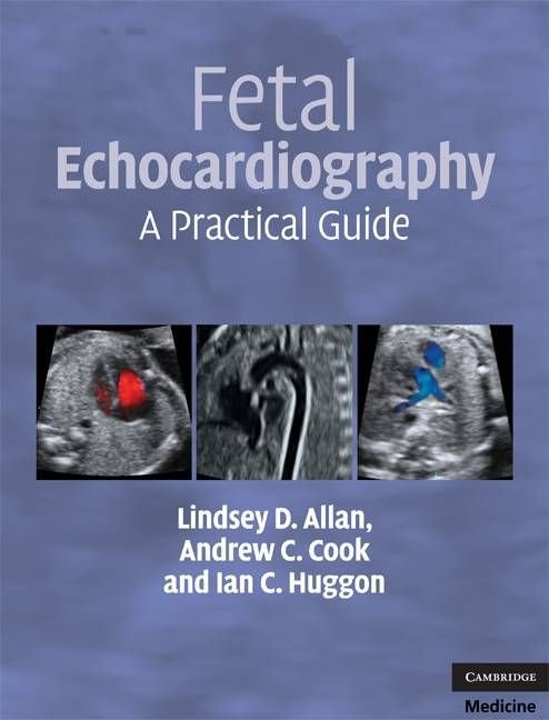 Buy Fetal Echocardiography By Lindsey D Allan With Free Delivery